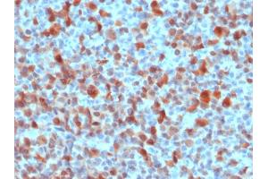 Formalin-fixed, paraffin-embedded human Melanoma stained with S100B Rabbit Polyclonal Antibody. (S100B Antikörper)