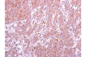 IHC-P Image PGD antibody detects PGD protein at cytoplasm on human breast carcinoma by immunohistochemical analysis. (PGD Antikörper)