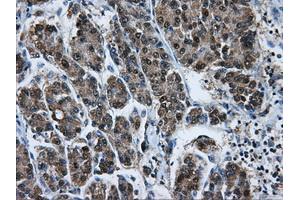 Immunohistochemical staining of paraffin-embedded Carcinoma of liver tissue using anti-HSPA1Amouse monoclonal antibody. (HSP70 1A Antikörper)