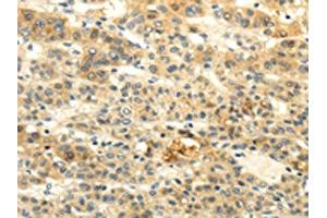 The image on the left is immunohistochemistry of paraffin-embedded Human liver cancer tissue using ABIN7190020(BRWD1 Antibody) at dilution 1/20, on the right is treated with synthetic peptide. (BRWD1 Antikörper)