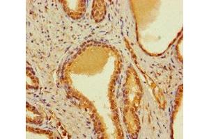 Immunohistochemistry of paraffin-embedded human prostate cancer using ABIN7148034 at dilution of 1:100 (CBWD2 Antikörper  (AA 96-395))