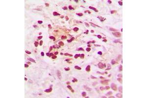 Immunohistochemical analysis of NCOR1 staining in human breast cancer formalin fixed paraffin embedded tissue section. (NCOR1 Antikörper  (N-Term))