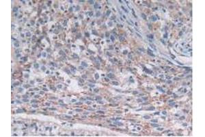 IHC-P analysis of Human Lung Cancer Tissue, with DAB staining. (SNX13 Antikörper  (AA 97-284))