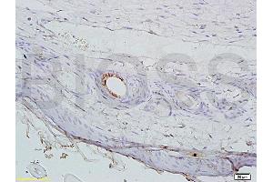 Formalin-fixed and paraffin embedded mouse cancer tissue labeled with Anti-AGPAT4 Polyclonal Antibody, Unconjugated (ABIN708671) at 1:200 followed by conjugation to the secondary antibody, (SP-0023), and DAB staining (AGPAT4 Antikörper  (AA 231-330))