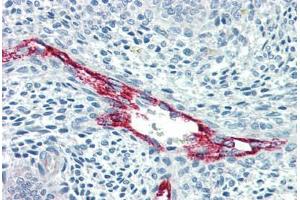 Human Uterus, Vessels (formalin-fixed, paraffin-embedded) stained with F8 antibody ABIN396921 at 10 ug/ml followed by biotinylated anti-mouse IgG secondary antibody ABIN481714, alkaline phosphatase-streptavidin and chromogen. (Factor VIII Antikörper)