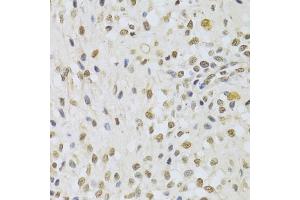 Immunohistochemistry of paraffin-embedded human uterine cancer using DNMT3A Antibody (ABIN5971621) at dilution of 1/100 (40x lens).