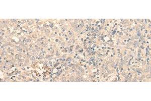 Immunohistochemistry of paraffin-embedded Human cervical cancer tissue using PNKD Polyclonal Antibody at dilution of 1:35(x200) (PNKD Antikörper)