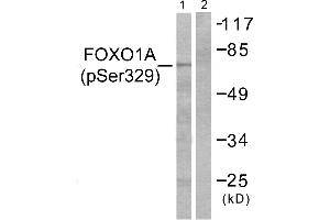 Immunohistochemistry analysis of paraffin-embedded human breast carcinoma tissue using FOXO1A (Phospho-Ser329) antibody. (FOXO1 Antikörper  (pSer329))