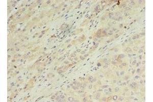 Immunohistochemistry of paraffin-embedded human liver cancer using ABIN7143481 at dilution of 1:100 (ARL14 Antikörper  (AA 2-192))