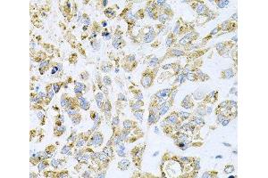 Immunohistochemistry of paraffin-embedded Human lung cancer using HDAC3 Polyclonal Antibody at dilution of 1:100 (40x lens). (HDAC3 Antikörper)