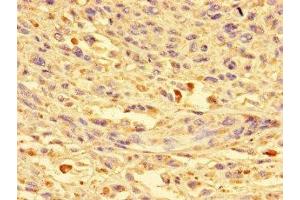 Immunohistochemistry of paraffin-embedded human melanoma using ABIN7149360 at dilution of 1:100 (CKAP2L Antikörper  (AA 246-413))