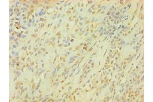 Immunohistochemistry of paraffin-embedded human breast cancer using ABIN7153564 at dilution of 1:100 (SNCG Antikörper  (AA 1-127))