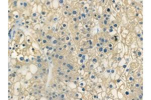 ABIN6266367 and ABIN6273361 at 1/100 staining human hepatocellular carcinoma by IHC-P. (LRRC42 Antikörper  (N-Term))