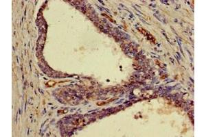 Immunohistochemistry of paraffin-embedded human prostate cancer using ABIN7152845 at dilution of 1:100 (FRS2 Antikörper  (AA 116-387))