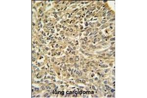 Merlin Antibody (N-term) (ABIN390756 and ABIN2841014) IHC analysis in formalin fixed and paraffin embedded human lung carcinoma followed by peroxidase conjugation of the secondary antibody and DAB staining. (Merlin Antikörper  (N-Term))