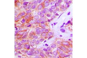 Immunohistochemical analysis of FGFR3 staining in human breast cancer formalin fixed paraffin embedded tissue section. (FGFR3 Antikörper  (Center))
