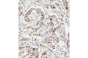 Immunohistochemical analysis of paraffin-embedded Human breast carcinoma tissue using A performed on the Leica® BOND RXm. (HIST1H3B3 (pSer10) Antikörper)