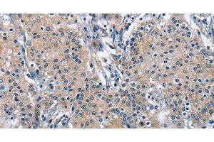 Immunohistochemistry of paraffin-embedded Human gastric cancer using TRIP4 Polyclonal Antibody at dilution of 1:50 (TRIP4 Antikörper)