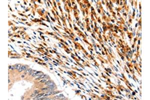 The image on the left is immunohistochemistry of paraffin-embedded Human colon cancer tissue using ABIN7192466(SLC2A5 Antibody) at dilution 1/12, on the right is treated with synthetic peptide. (SLC2A5 Antikörper)