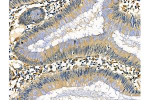 ABIN6261064 and ABIN6276721 at 1/100 staining Human colorectal cancer by IHC-P.