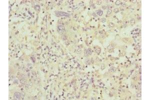 Immunohistochemistry of paraffin-embedded human liver cancer using ABIN7148371 at dilution of 1:100