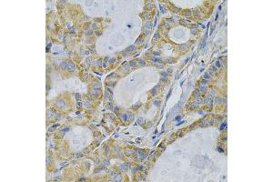Immunohistochemistry of paraffin-embedded human thyroid cancer using TLR7 Antibody (ABIN5970379) at dilution of 1/100 (40x lens).