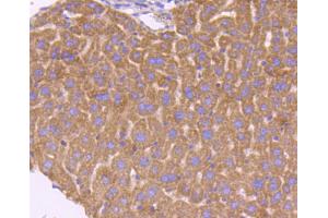 Paraformaldehyde-fixed, paraffin embedded human lung cancer, Antigen retrieval by boiling in sodium citrate buffer (pH6) for 15min, Block endogenous peroxidase by 3% hydrogen peroxide for 30 minutes, Blocking buffer at 37°C for 20min, Antibody incubation with Smad3 (3D1) Monoclonal Antibody  at 1:50 overnight at 4°C, followed by a conjugated secondary and DAB staining. (SMAD3 Antikörper)