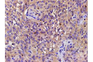 ABIN6267443 at 1/200 staining human meningeal carcinomatosis(MC) tissue sections by IHC-P.