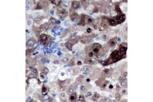 Immunohistochemical analysis of Geminin staining in human liver cancer formalin fixed paraffin embedded tissue section. (Geminin Antikörper)