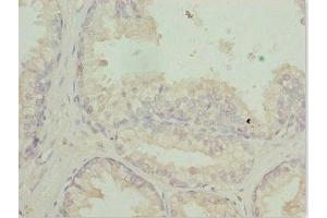 Immunohistochemistry of paraffin-embedded human prostate cancer using ABIN7167729 at dilution of 1:100 (RFPL2 Antikörper  (AA 99-378))