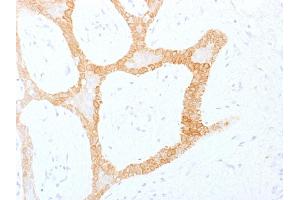 Formalin-fixed, paraffin-embedded human Colon Carcinoma stained with Cytokeratin 5/8 Monoclonal Antibody (C-50). (Keratin 5/8 Antikörper)
