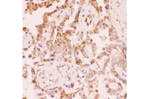 Anti-SIRT2 Picoband antibody,  IHC(P): Human Lung Cancer Tissue (SIRT2 Antikörper  (Middle Region))