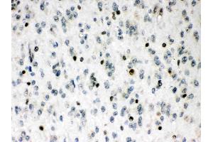 MEF2A was detected in paraffin-embedded sections of human glioma tissues using rabbit anti- MEF2A Antigen Affinity purified polyclonal antibody (Catalog # ) at 1 µg/mL.