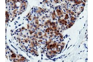 Immunohistochemical staining of paraffin-embedded Adenocarcinoma of Human breast tissue using anti-AK5 mouse monoclonal antibody. (Adenylate Kinase 5 Antikörper)