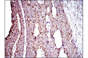 Immunohistochemical analysis of paraffin-embedded rectum cancer tissues using ALDH2 mouse mAb with DAB staining. (ALDH2 Antikörper  (AA 317-517))
