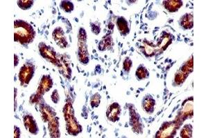 Formalin-fixed, paraffin-embedded human breast carcinoma stained with TFF1 antibody. (TFF1 Antikörper  (C-Term))