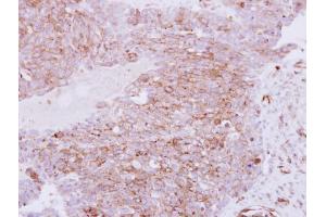 IHC-P Image Immunohistochemical analysis of paraffin-embedded human ovarian carcinoma, using RhoC, antibody at 1:250 dilution. (RHOC Antikörper)