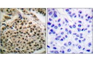 Immunohistochemistry analysis of paraffin-embedded human breast carcinoma, using NF-kappaB p105/p50 (Phospho-Ser927) Antibody. (NFKB1 Antikörper  (pSer927))