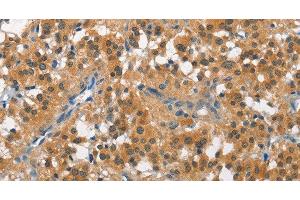 Immunohistochemistry of paraffin-embedded Human thyroid cancer tissue using CUL7 Polyclonal Antibody at dilution 1:50 (Cullin 7 Antikörper)