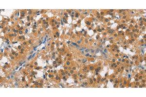 Immunohistochemistry of paraffin-embedded Human thyroid cancer tissue using CUL7 Polyclonal Antibody at dilution 1:50