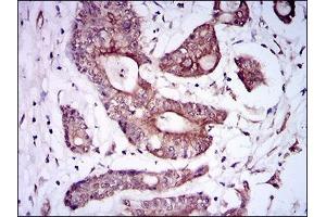 Immunohistochemical analysis of paraffin-embedded colon cancer tissues using BMPR1A mouse mAb with DAB staining. (BMPR1A Antikörper  (AA 179-378))