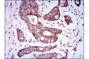 Immunohistochemical analysis of paraffin-embedded colon cancer tissues using BMPR1A mouse mAb with DAB staining.