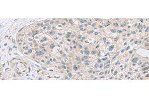Immunohistochemistry of paraffin-embedded Human esophagus cancer tissue using ABCA10 Polyclonal Antibody at dilution of 1:50(x200) (ABCA10 Antikörper)