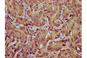 IHC image of ABIN7171794 diluted at 1:800 and staining in paraffin-embedded human liver cancer performed on a Leica BondTM system. (TES Antikörper  (AA 130-260))