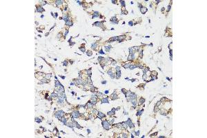 Immunohistochemistry of paraffin-embedded human gastric cancer using TSC1 antibody (ABIN6133755, ABIN6149609, ABIN6149610 and ABIN6213968) at dilution of 1:200 (40x lens). (TSC1 Antikörper  (AA 550-650))