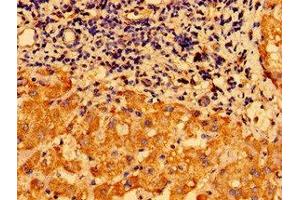 Immunohistochemistry of paraffin-embedded human liver cancer using ABIN7147612 at dilution of 1:100 (CHDH Antikörper  (AA 30-223))