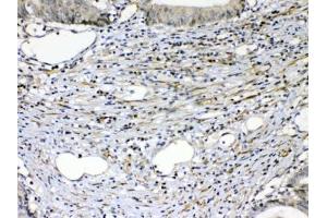 IHC testing of FFPE human intestinal cancer tissue with VEGFR2 antibody at 1ug/ml. (VEGFR2/CD309 Antikörper)