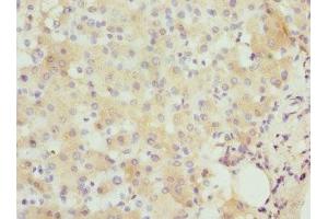 Immunohistochemistry of paraffin-embedded human liver cancer using ABIN7156584 at dilution of 1:100 (IFNB1 Antikörper  (AA 22-187))