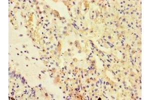 Immunohistochemistry of paraffin-embedded human lung cancer using ABIN7175178 at dilution of 1:100 (UVRAG Antikörper  (AA 375-425))