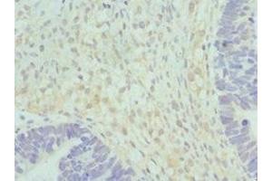 Immunohistochemistry of paraffin-embedded human ovarian cancer using ABIN7152037 at dilution of 1:100 (HSD17B2 Antikörper  (AA 118-387))
